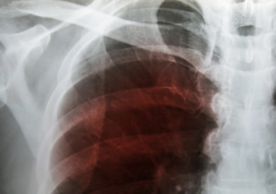 X-ray image of tuberculosis.  Photo credit:  Courtesy of Dreamstime